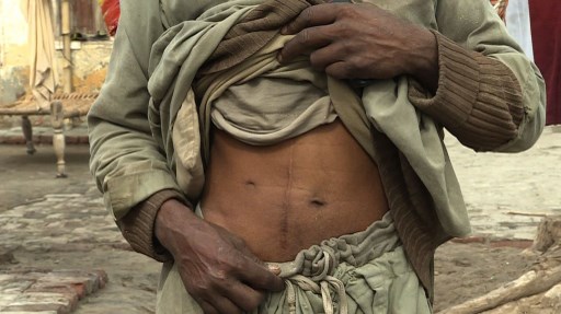 Wealth and poverty propping up Pakistan's illegal kidney trade