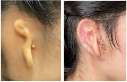 Surgeons transplant 3D ear made of living cells.jpg